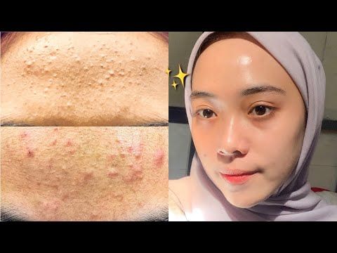 Skincare penghilang bruntusan
