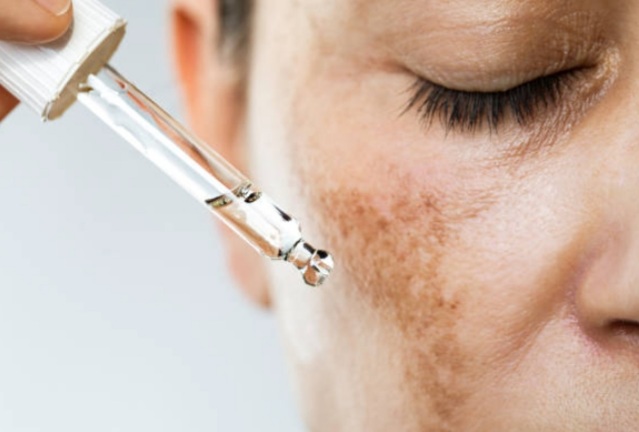 Tips dan Cara Ampuh Mengatasi Flek Hitam di Wajah Bagi Usia 40 Tahun